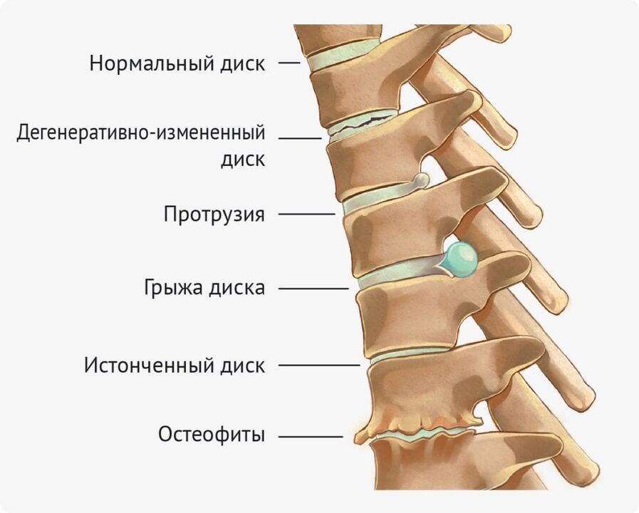 Diska kroplības jostas osteohondrozei