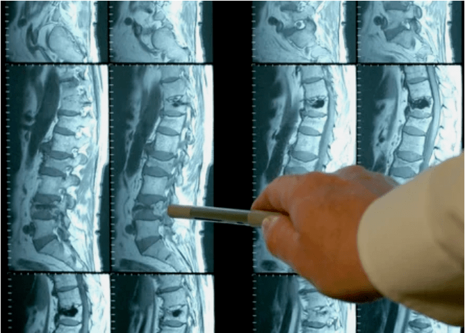 Osteohondrozes šķirnes mugurkaulā