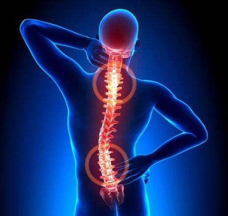 Mugurkaula osteohondroze