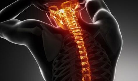 Visa mugurkaula osteohondroze