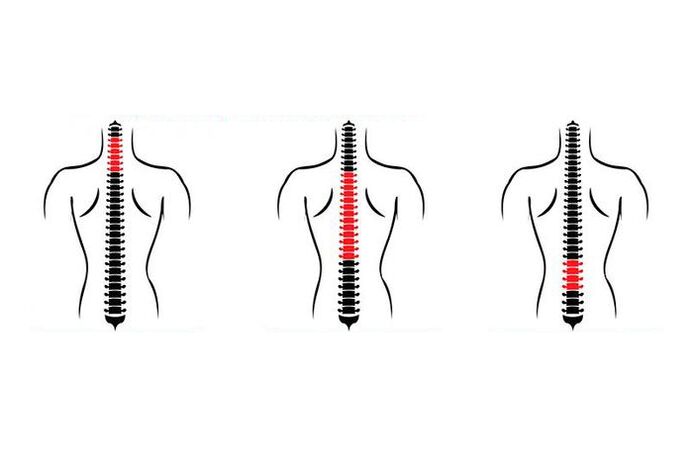 Kā izpaužas osteohondroze
